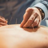 acupunctura