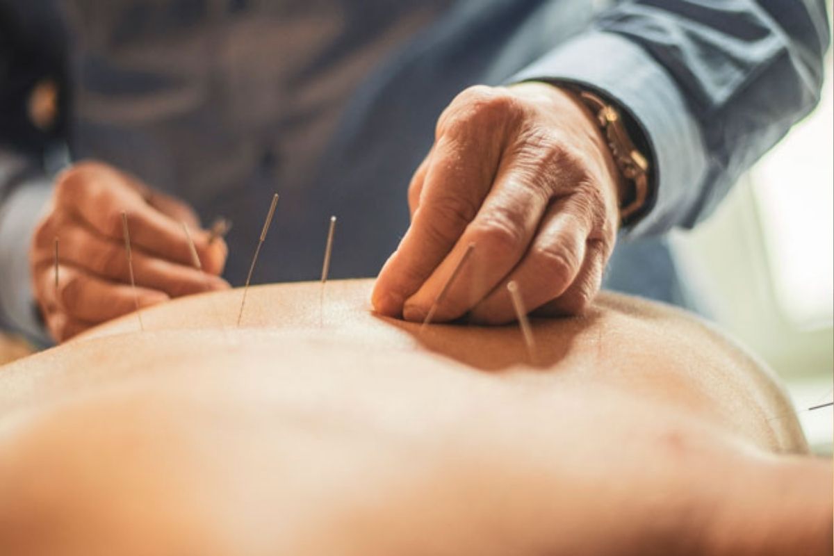 acupunctura