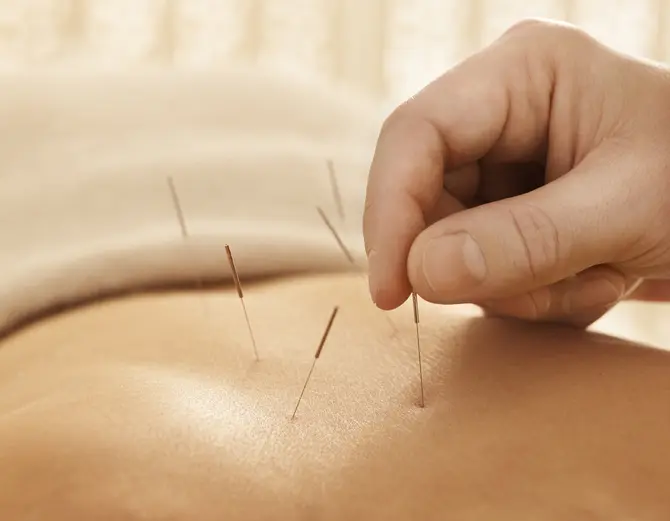 Acupunctura