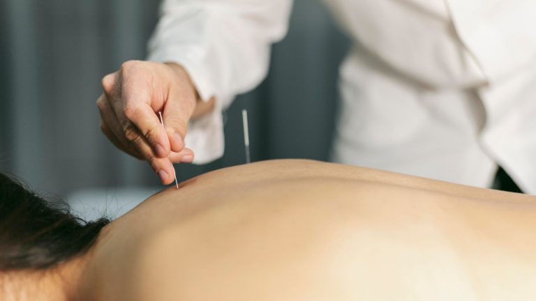 acupunctura sedinte